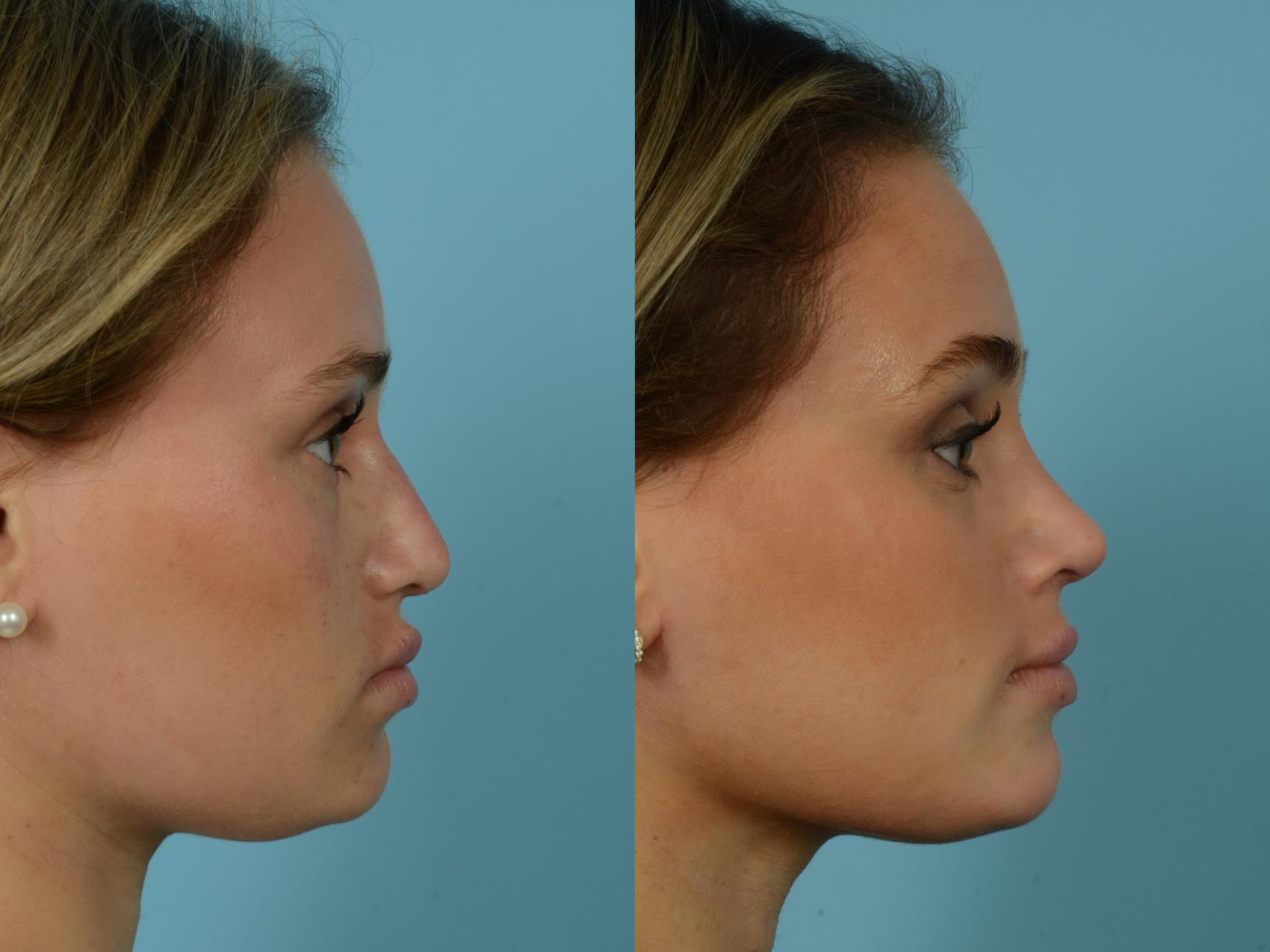 Before & After Rhinoplasty by Dr. Sinno Case 777 Right Side View in Chicago, IL
