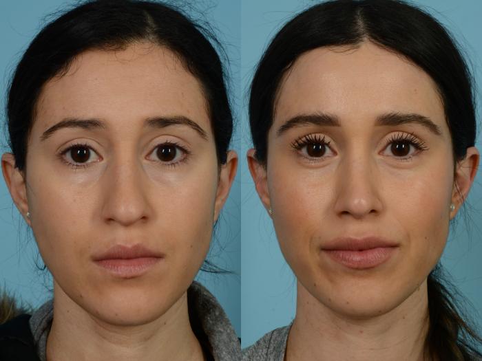 Before & After Rhinoplasty by Dr. Sinno Case 778 Front View in Chicago, IL