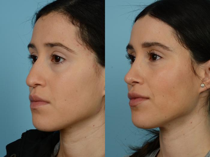 Before & After Rhinoplasty by Dr. Sinno Case 778 Left Oblique View in Chicago, IL