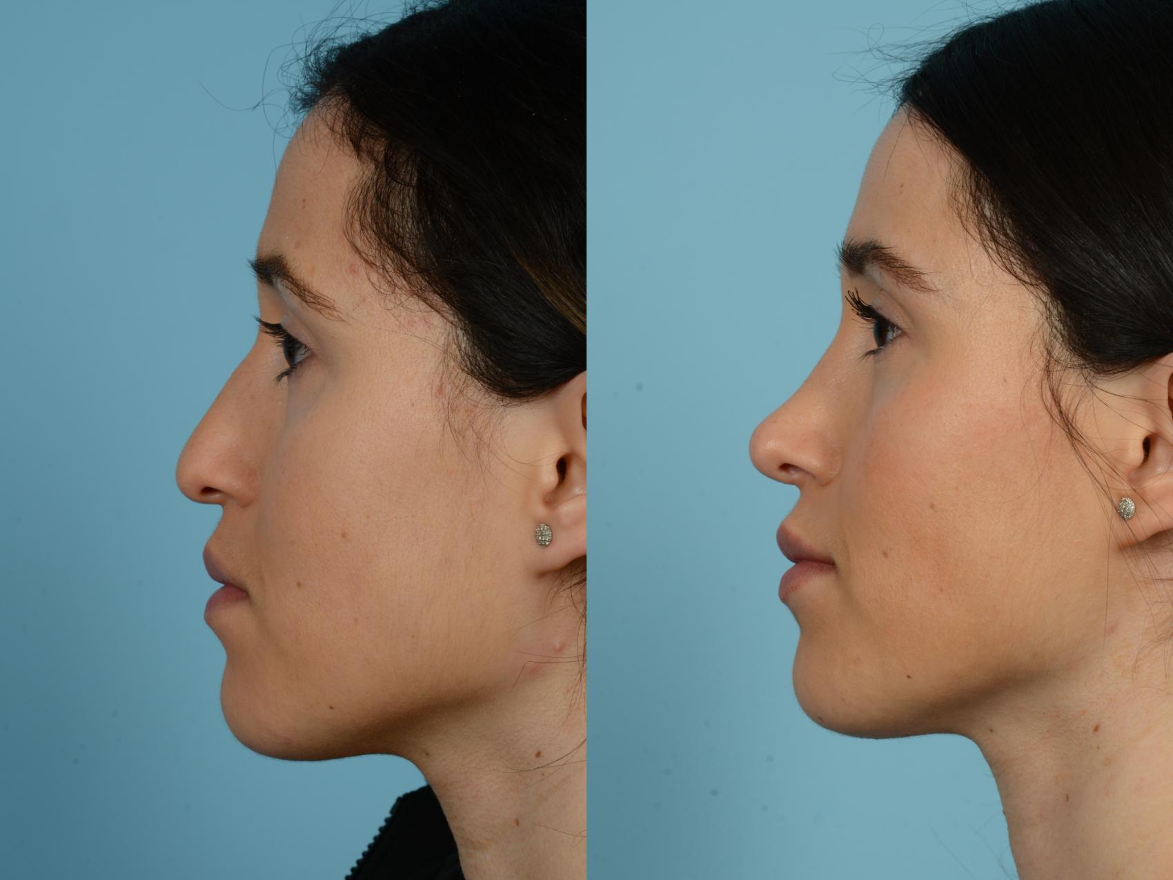 Before & After Rhinoplasty by Dr. Sinno Case 778 Left Side View in Chicago, IL
