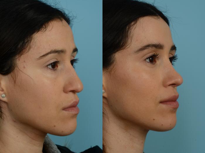 Before & After Rhinoplasty by Dr. Sinno Case 778 Right Oblique View in Chicago, IL