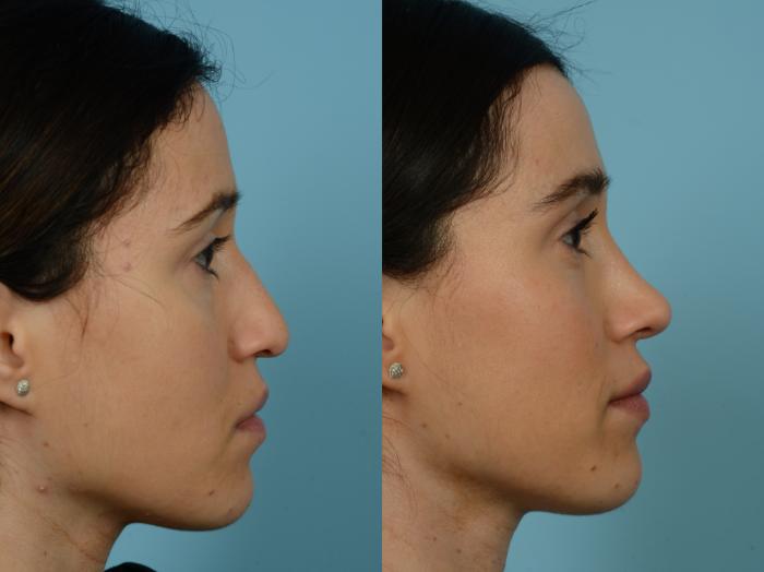 Before & After Rhinoplasty by Dr. Sinno Case 778 Right Side View in Chicago, IL