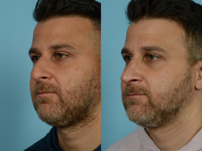 Before & After Rhinoplasty by Dr. Sinno Case 779 Left Oblique View in Chicago, IL