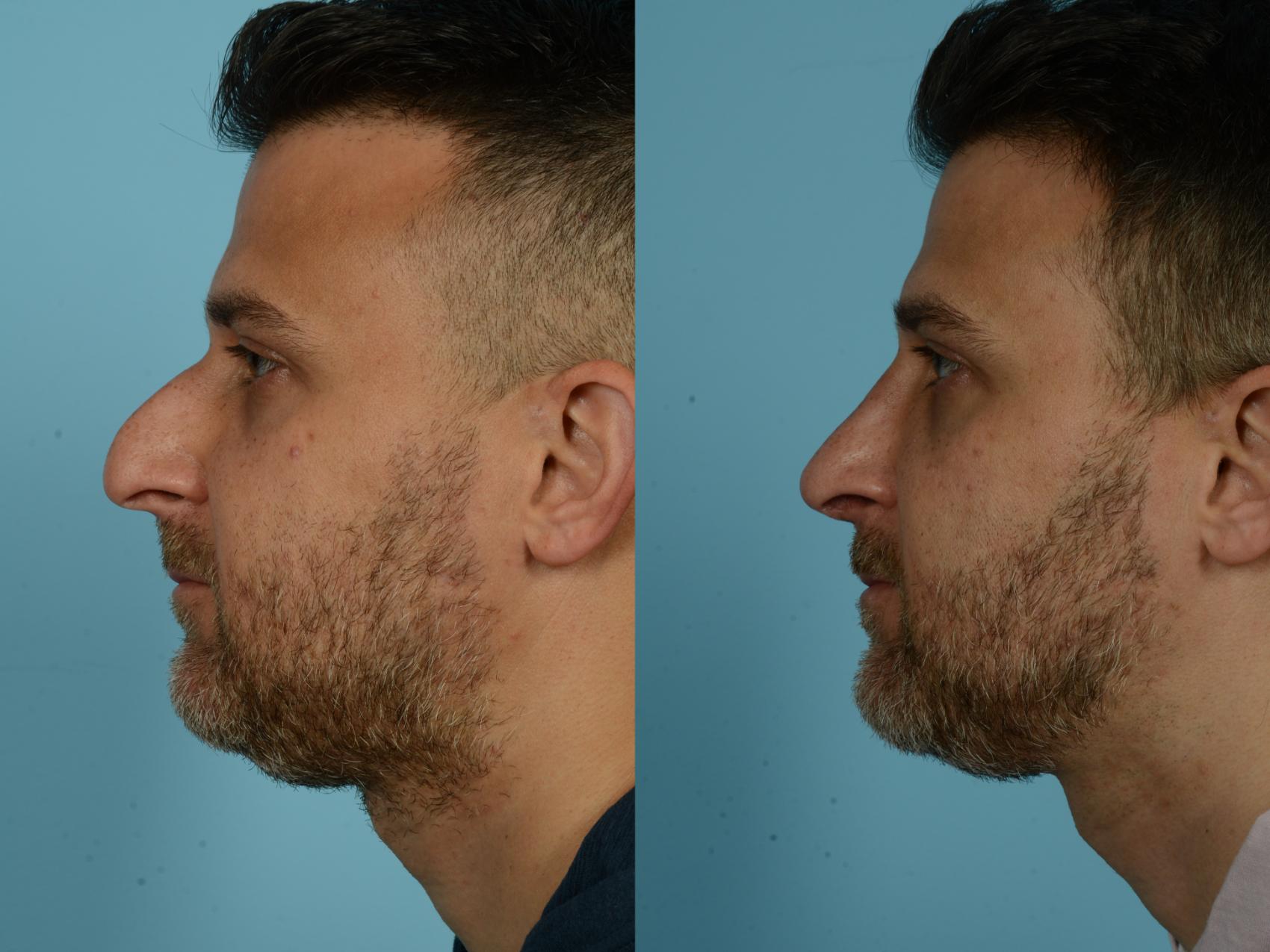 Before & After Rhinoplasty by Dr. Sinno Case 779 Left Side View in Chicago, IL