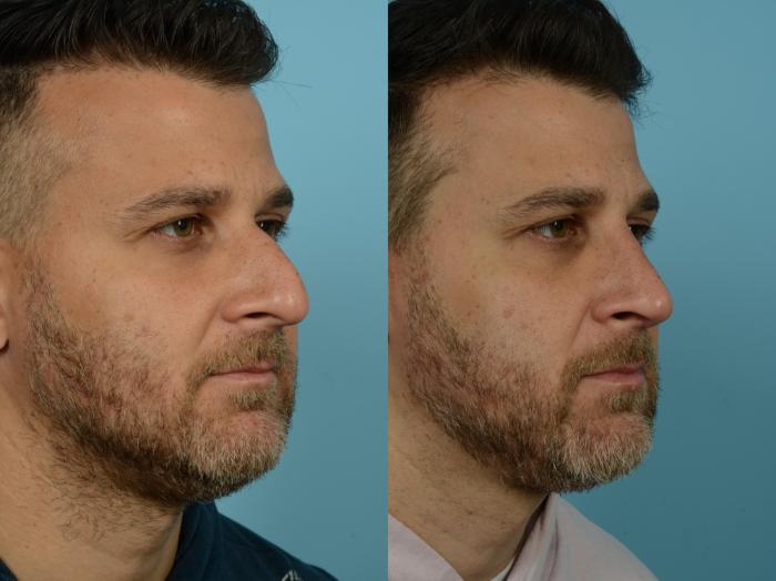 Before & After Rhinoplasty by Dr. Sinno Case 779 Right Oblique View in Chicago, IL