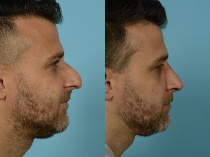 Before & After Rhinoplasty by Dr. Sinno Case 779 Right Side View in Chicago, IL