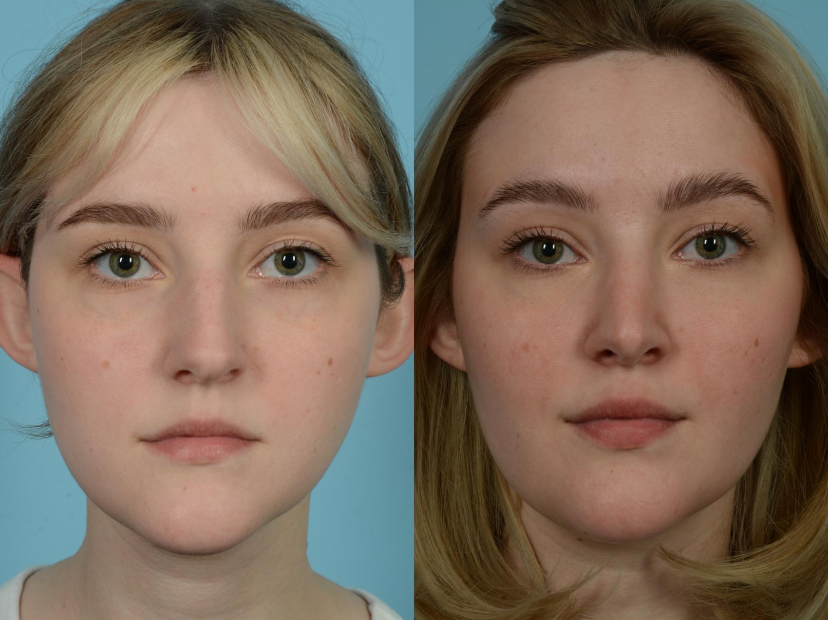 Before & After Rhinoplasty by Dr. Sinno Case 782 Front View in Chicago, IL