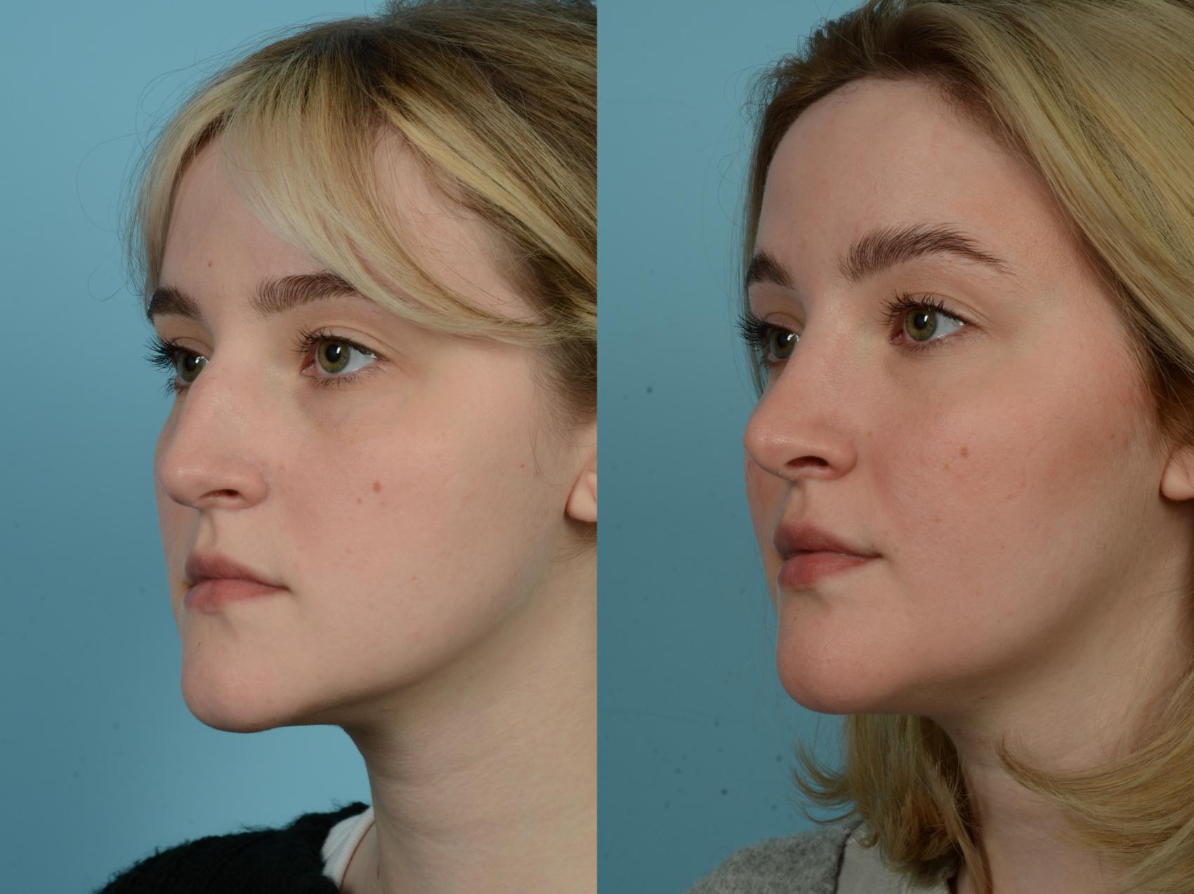 Before & After Rhinoplasty by Dr. Sinno Case 782 Left Oblique View in Chicago, IL