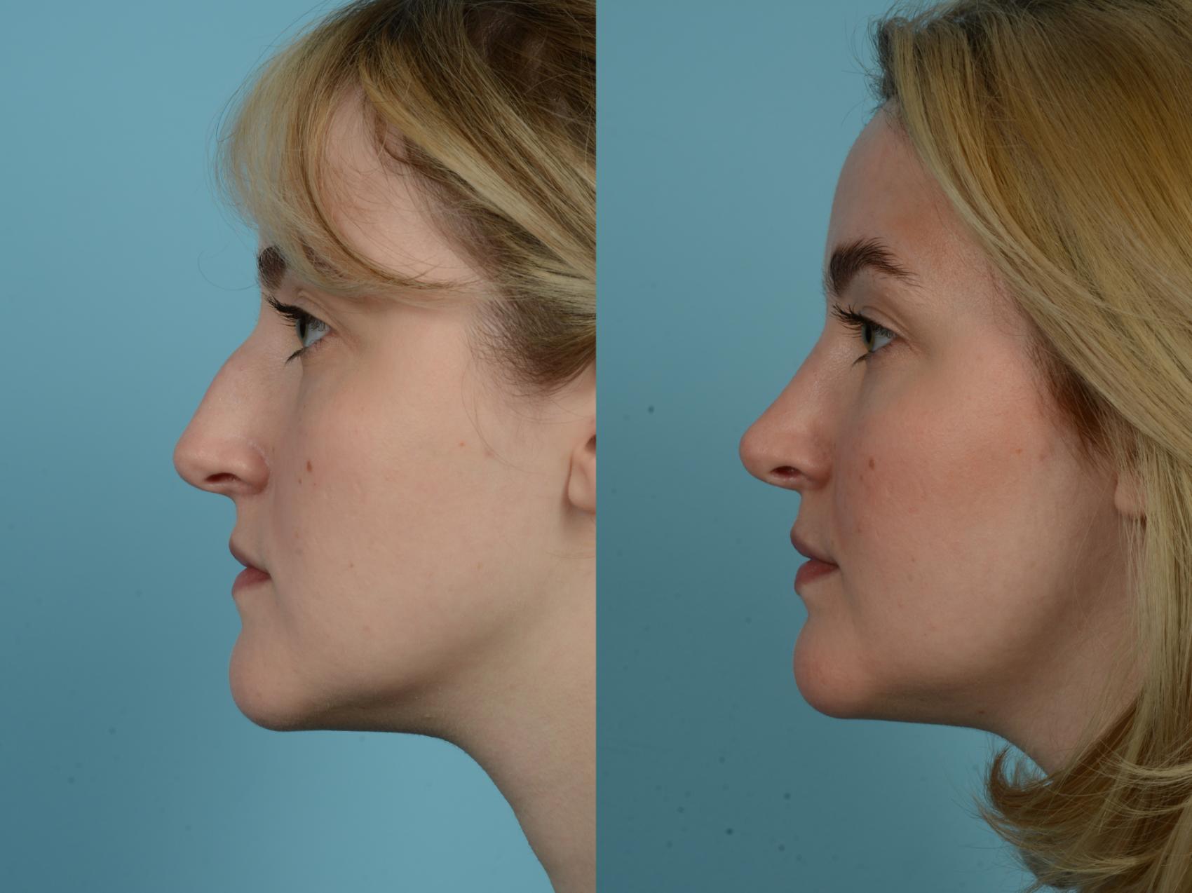 Before & After Rhinoplasty by Dr. Sinno Case 782 Left Side View in Chicago, IL