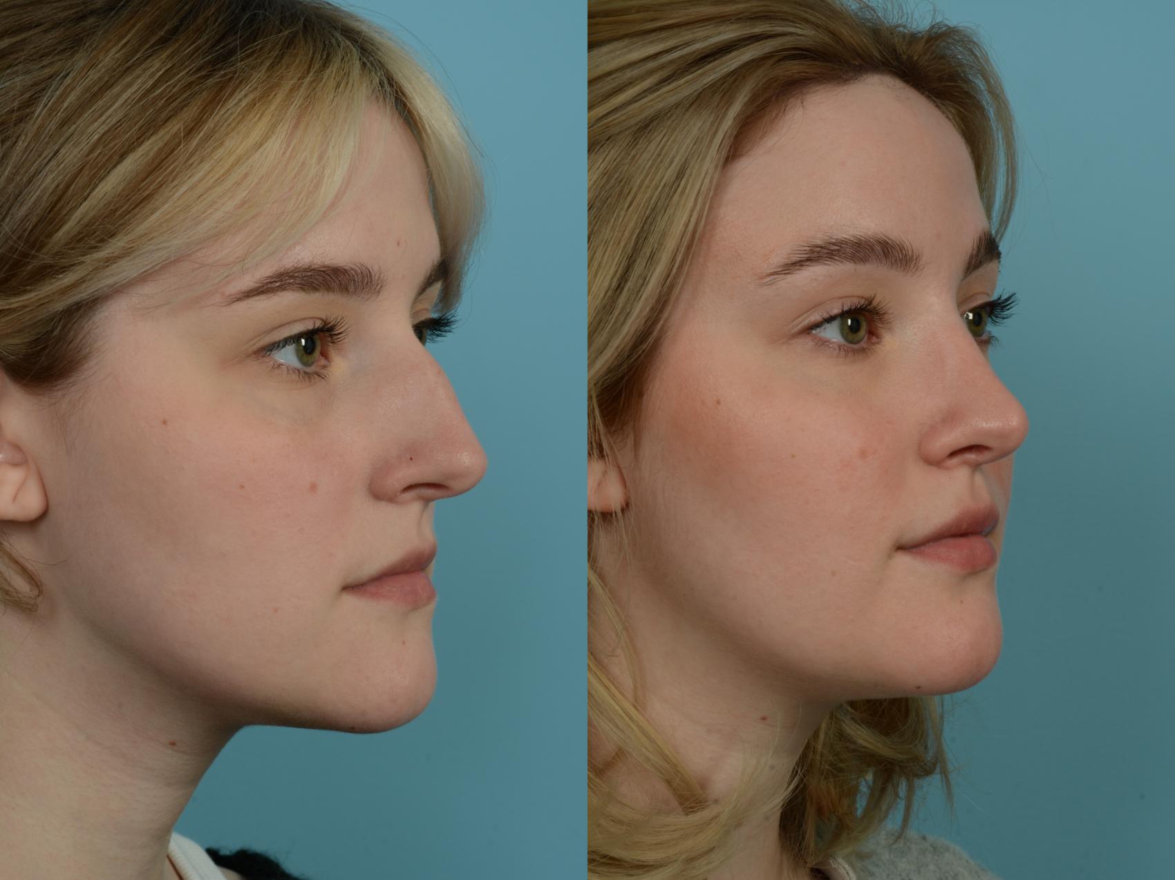 Before & After Rhinoplasty by Dr. Sinno Case 782 Right Oblique View in Chicago, IL
