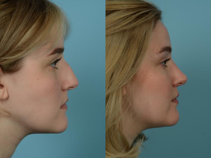 Before & After Rhinoplasty by Dr. Sinno Case 782 Right Side View in Chicago, IL