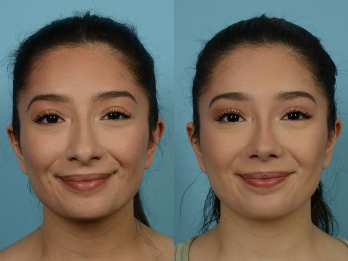 Before & After Rhinoplasty by Dr. Sinno Case 787 Front View in Chicago, IL