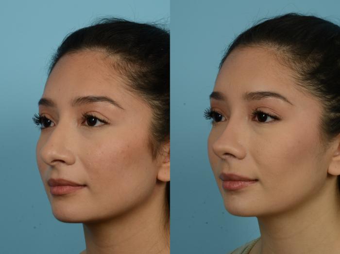 Before & After Rhinoplasty by Dr. Sinno Case 787 Left Oblique View in Chicago, IL