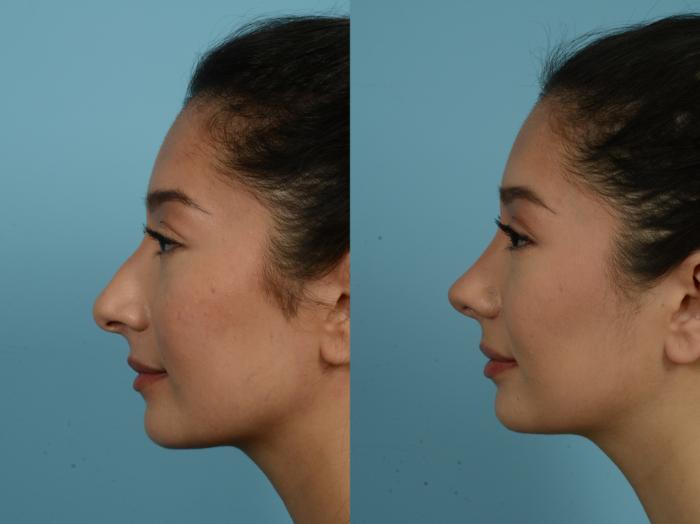 Before & After Rhinoplasty by Dr. Sinno Case 787 Left Side View in Chicago, IL