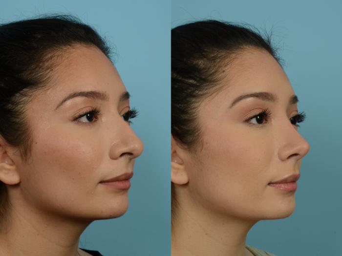 Before & After Rhinoplasty by Dr. Sinno Case 787 Right Oblique View in Chicago, IL