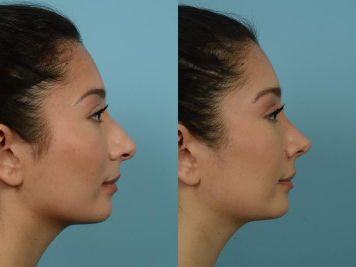 Before & After Rhinoplasty by Dr. Sinno Case 787 Right Side View in Chicago, IL