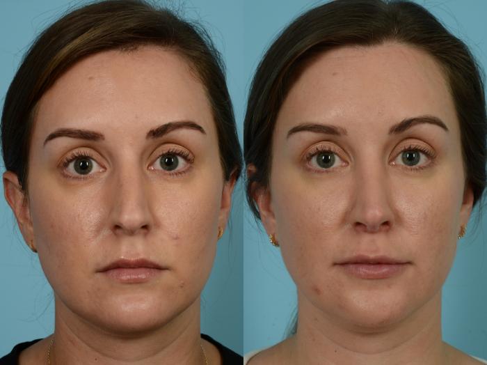 Before & After Rhinoplasty by Dr. Sinno Case 791 Front View in Chicago, IL