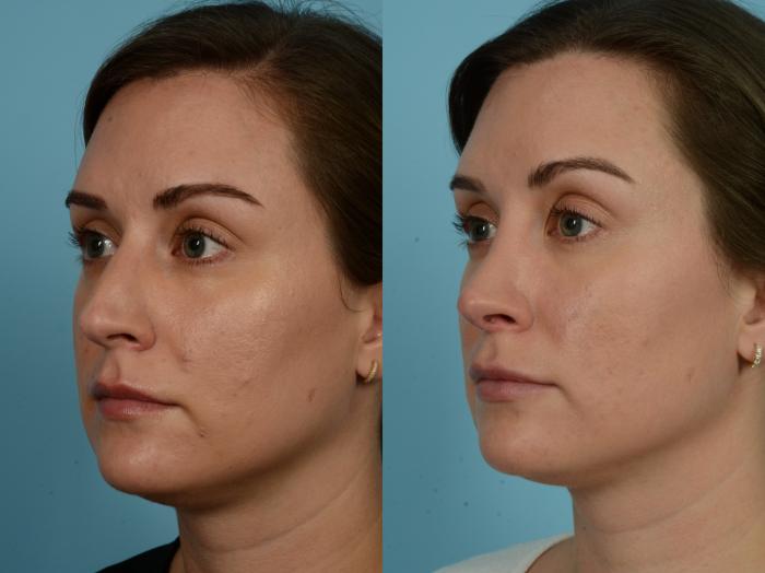 Before & After Rhinoplasty by Dr. Sinno Case 791 Left Oblique View in Chicago, IL