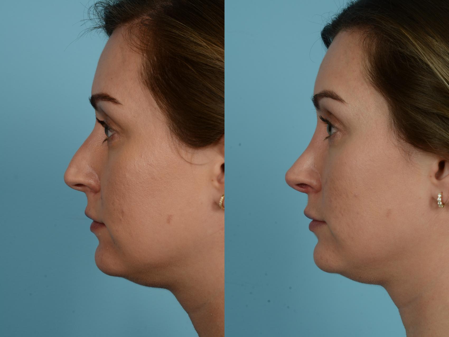 Before & After Rhinoplasty by Dr. Sinno Case 791 Left Side View in Chicago, IL