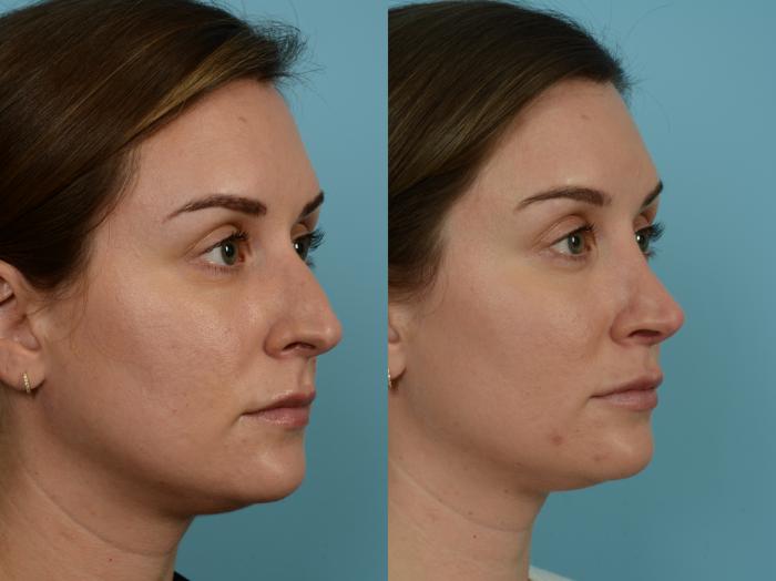 Before & After Rhinoplasty by Dr. Sinno Case 791 Right Oblique View in Chicago, IL
