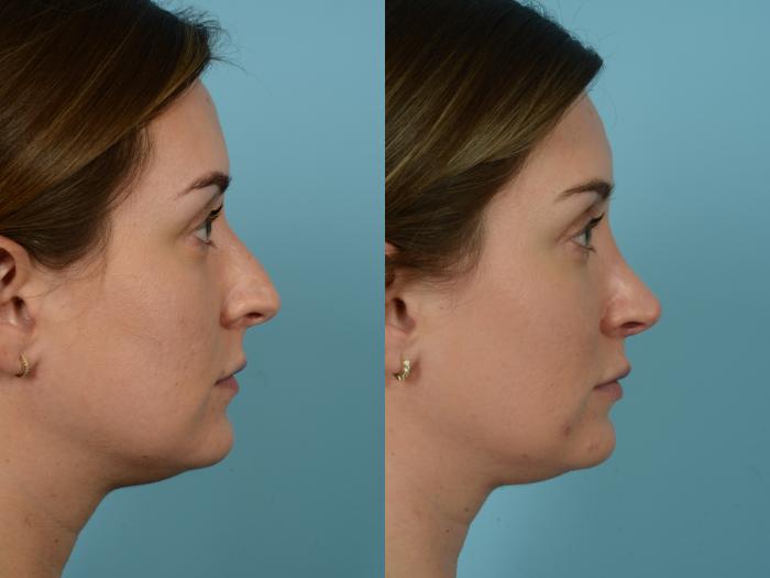 Before & After Rhinoplasty by Dr. Sinno Case 791 Right Side View in Chicago, IL