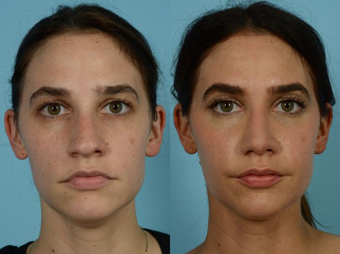 Before & After Rhinoplasty by Dr. Sinno Case 792 Front View in Chicago, IL