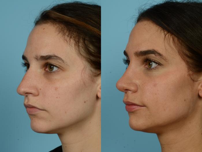 Before & After Rhinoplasty by Dr. Sinno Case 792 Left Oblique View in Chicago, IL