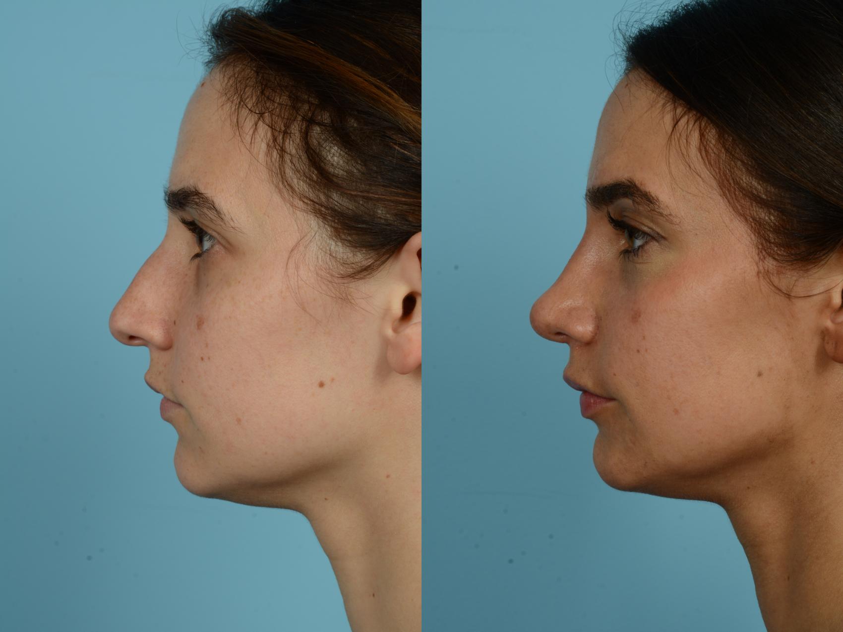Before & After Rhinoplasty by Dr. Sinno Case 792 Left Side View in Chicago, IL