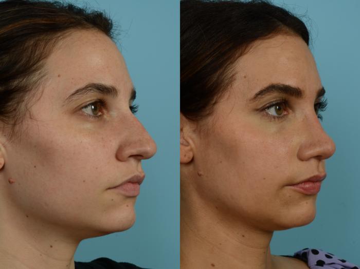 Before & After Rhinoplasty by Dr. Sinno Case 792 Right Oblique View in Chicago, IL