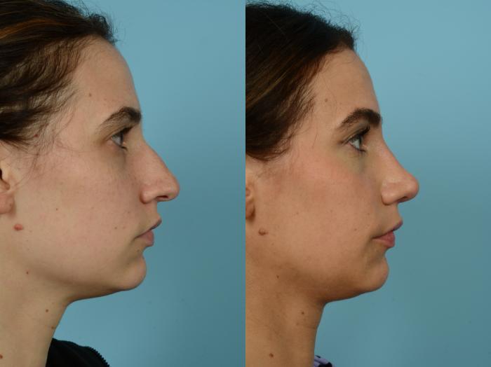 Before & After Rhinoplasty by Dr. Sinno Case 792 Right Side View in Chicago, IL