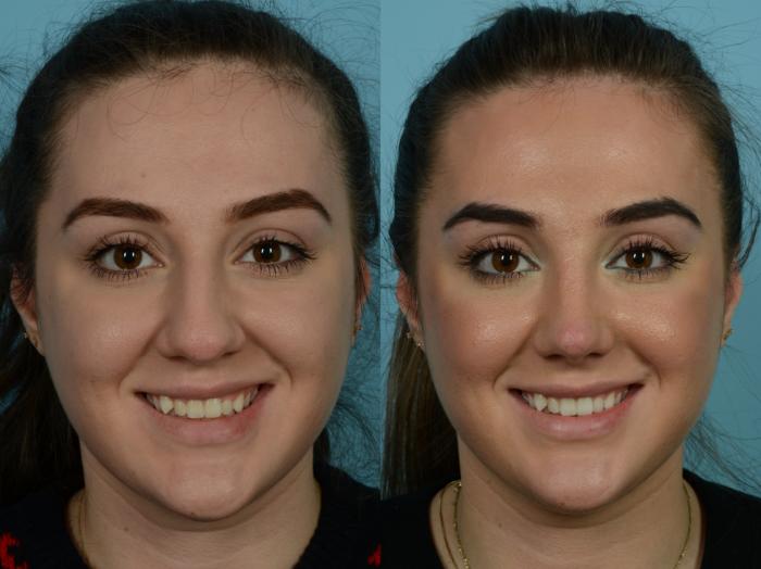 Before & After Rhinoplasty by Dr. Sinno Case 793 Front View in Chicago, IL