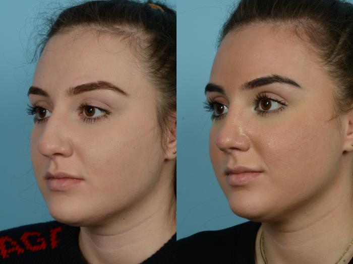 Before & After Rhinoplasty by Dr. Sinno Case 793 Left Oblique View in Chicago, IL