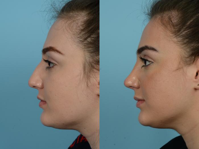Before & After Rhinoplasty by Dr. Sinno Case 793 Left Side View in Chicago, IL