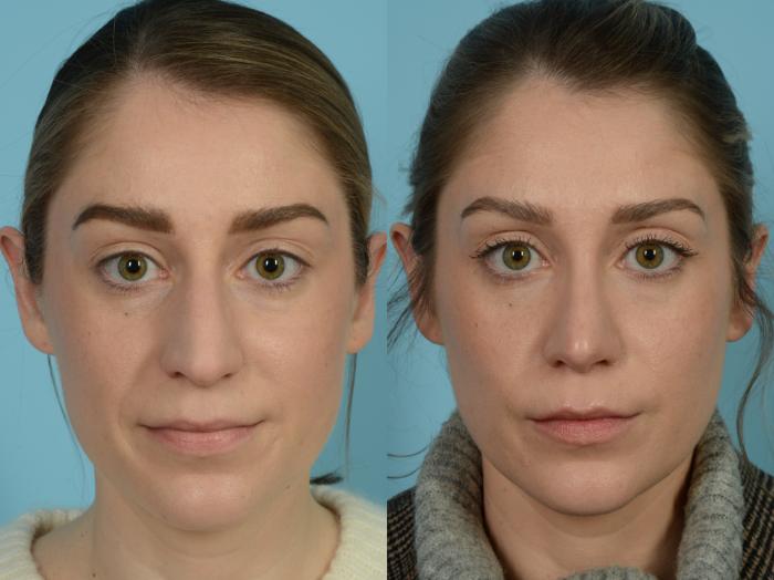 Before & After Rhinoplasty by Dr. Sinno Case 807 Front View in Chicago, IL