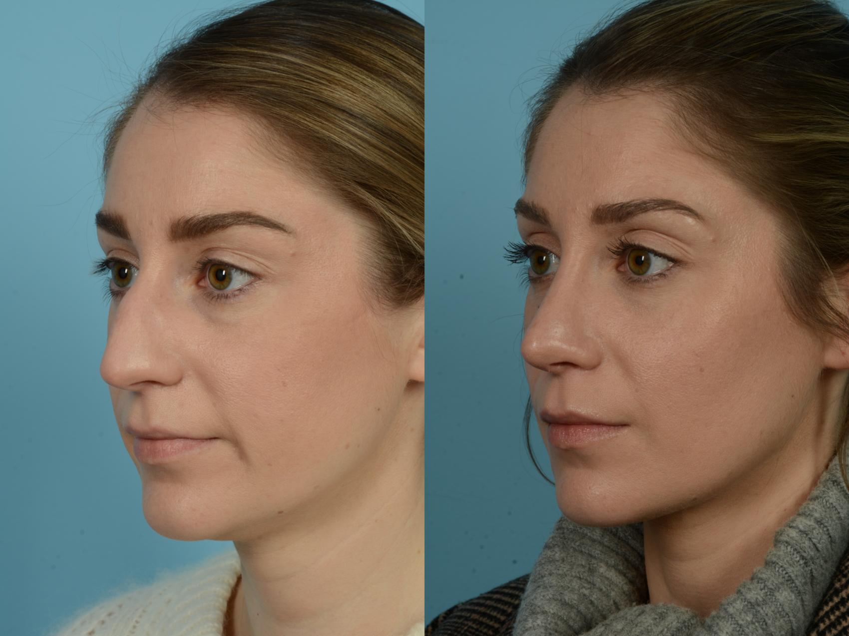 Rhinoplasty By Dr Sinno Before And After Pictures Case 807 Chicago Il Tlkm Plastic Surgery 