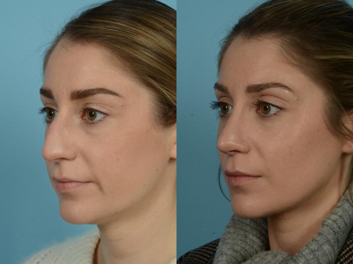 Before & After Rhinoplasty by Dr. Sinno Case 807 Left Oblique View in Chicago, IL