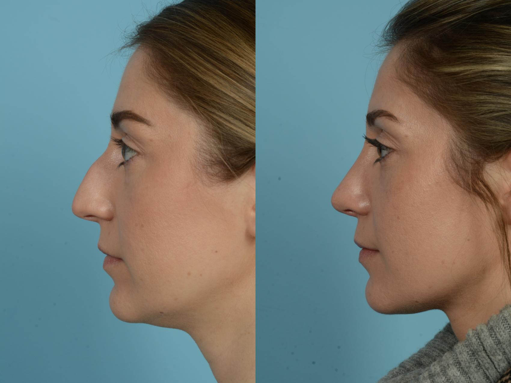 Before & After Rhinoplasty by Dr. Sinno Case 807 Left Side View in Chicago, IL