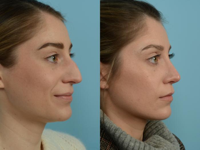 Before & After Rhinoplasty by Dr. Sinno Case 807 Right Oblique View in Chicago, IL