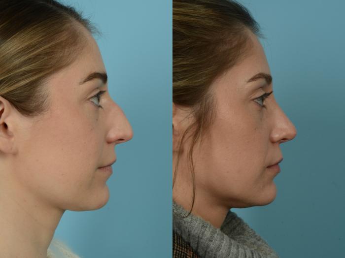 Before & After Rhinoplasty by Dr. Sinno Case 807 Right Side View in Chicago, IL