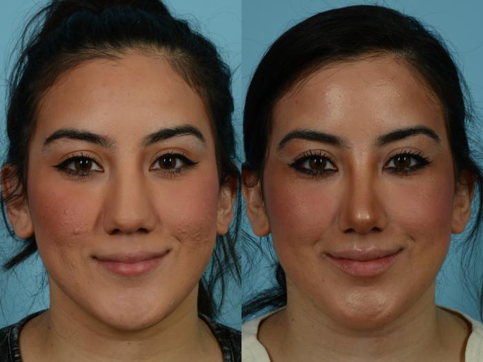 Before & After Rhinoplasty by Dr. Sinno Case 813 Front View in Chicago, IL