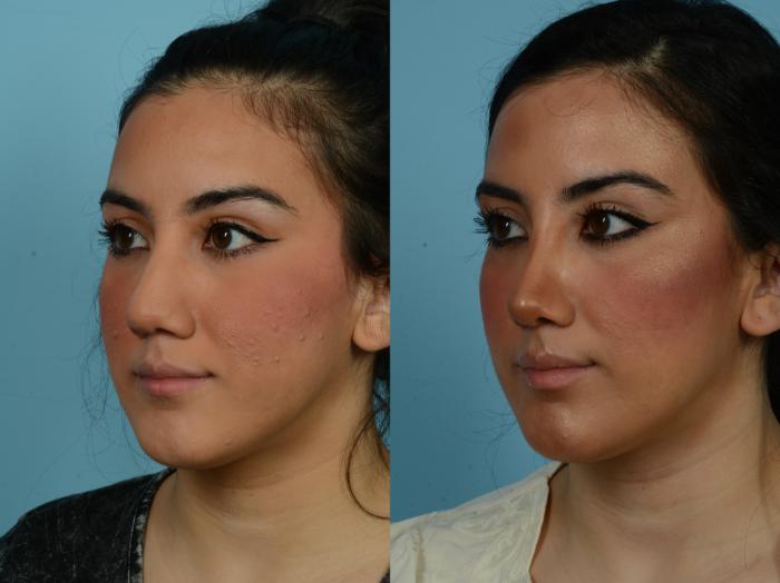 Before & After Rhinoplasty by Dr. Sinno Case 813 Left Oblique View in Chicago, IL