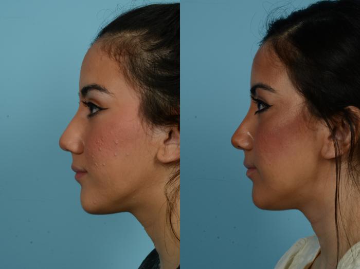 Before & After Rhinoplasty by Dr. Sinno Case 813 Left Side View in Chicago, IL