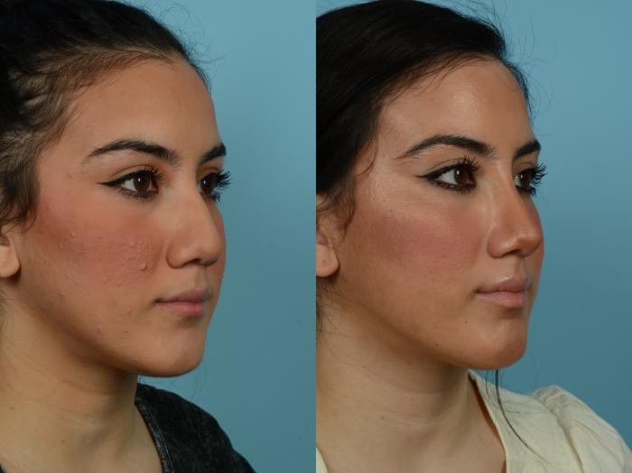 Before & After Rhinoplasty by Dr. Sinno Case 813 Right Oblique View in Chicago, IL