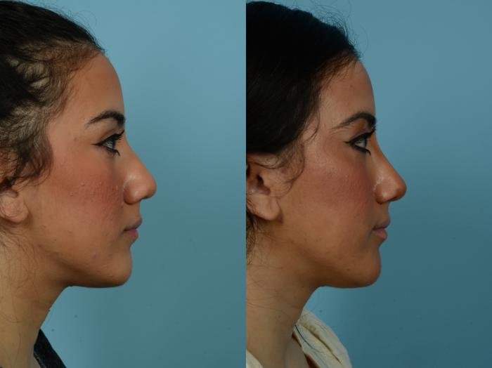 Before & After Rhinoplasty by Dr. Sinno Case 813 Right Side View in Chicago, IL