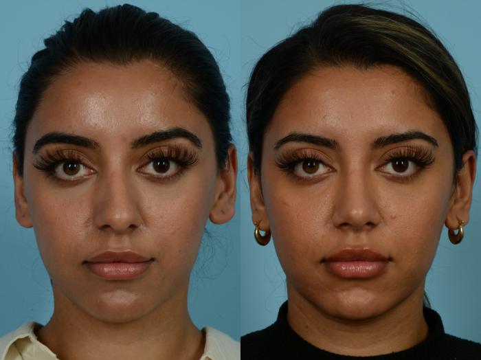 Before & After Rhinoplasty by Dr. Sinno Case 845 Front View in Chicago, IL