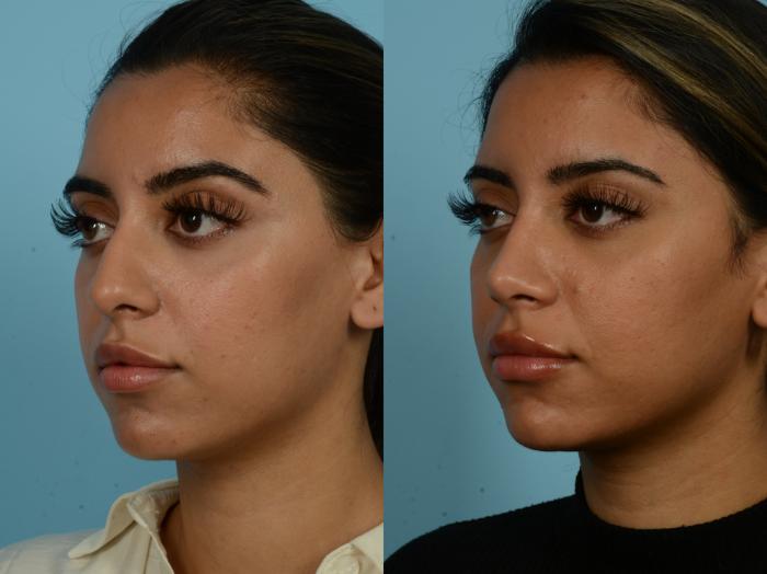 Before & After Rhinoplasty by Dr. Sinno Case 845 Left Oblique View in Chicago, IL
