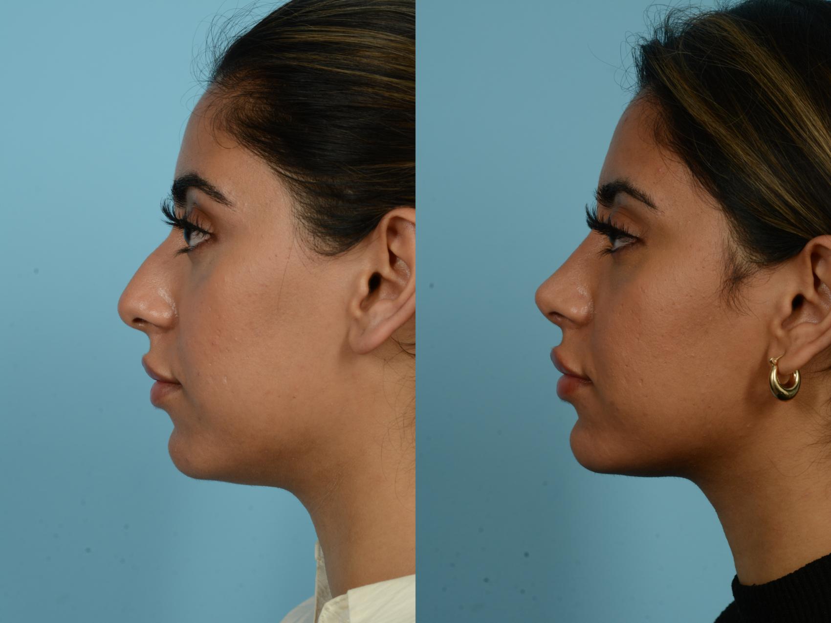 Before & After Rhinoplasty by Dr. Sinno Case 845 Left Side View in Chicago, IL