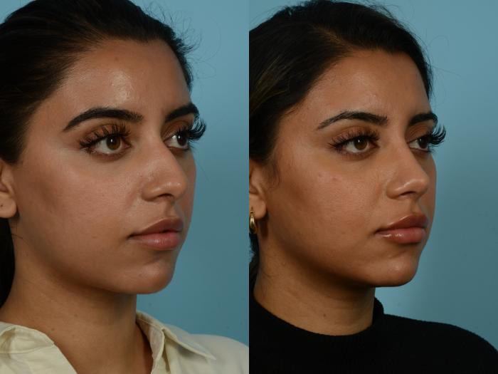 Before & After Rhinoplasty by Dr. Sinno Case 845 Right Oblique View in Chicago, IL