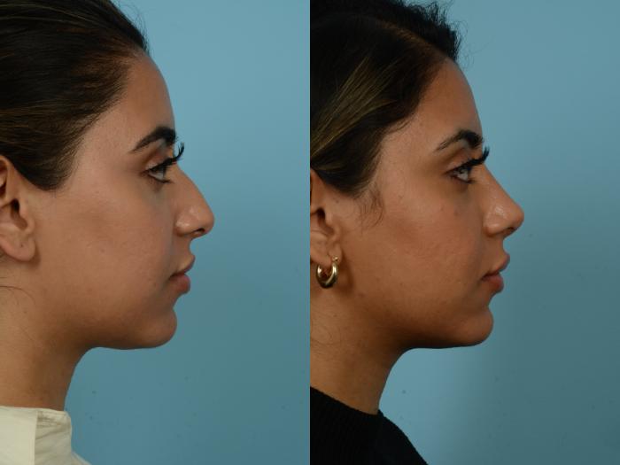 Before & After Rhinoplasty by Dr. Sinno Case 845 Right Side View in Chicago, IL