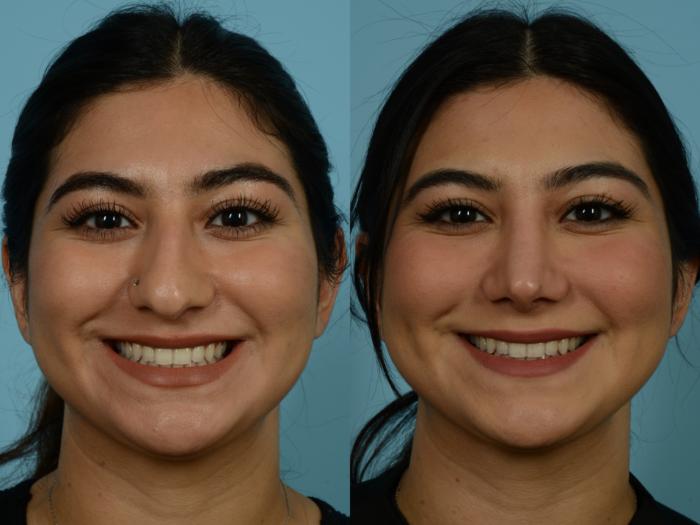 Before & After Rhinoplasty by Dr. Sinno Case 846 Front View in Chicago, IL